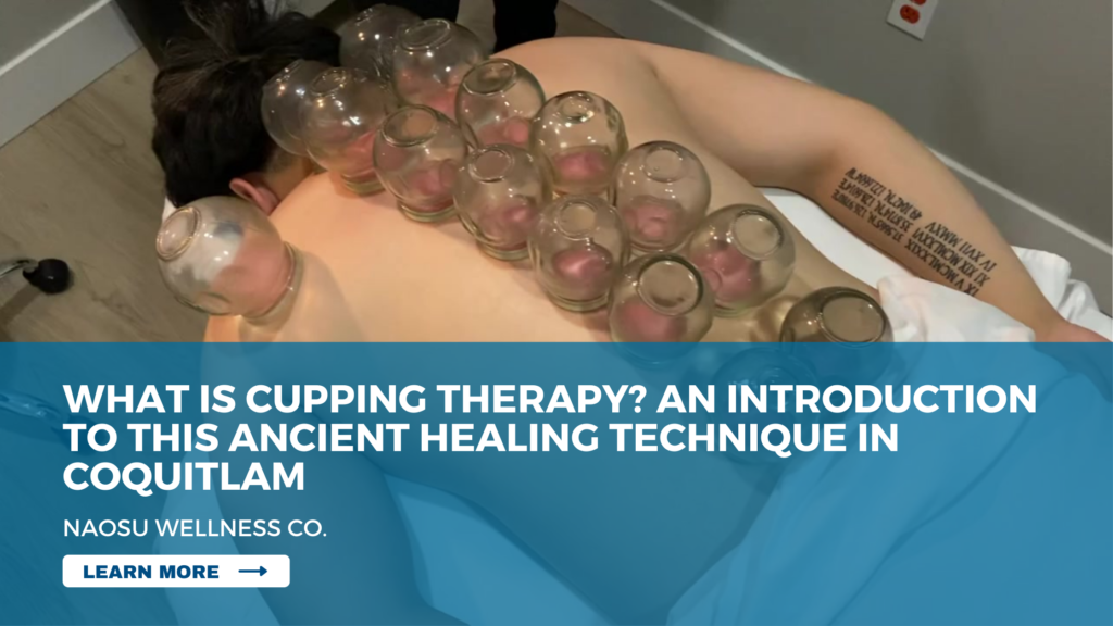 What is Cupping Therapy? An Introduction to This Ancient Healing Technique in Coquitlam